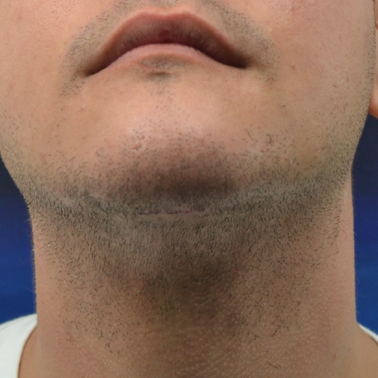 mentoplastia-2