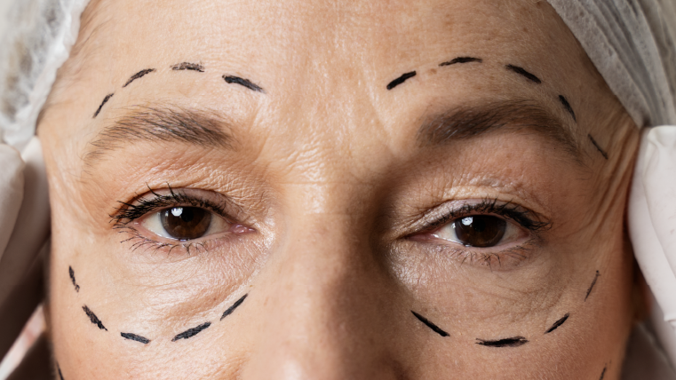 Blefaroplastia