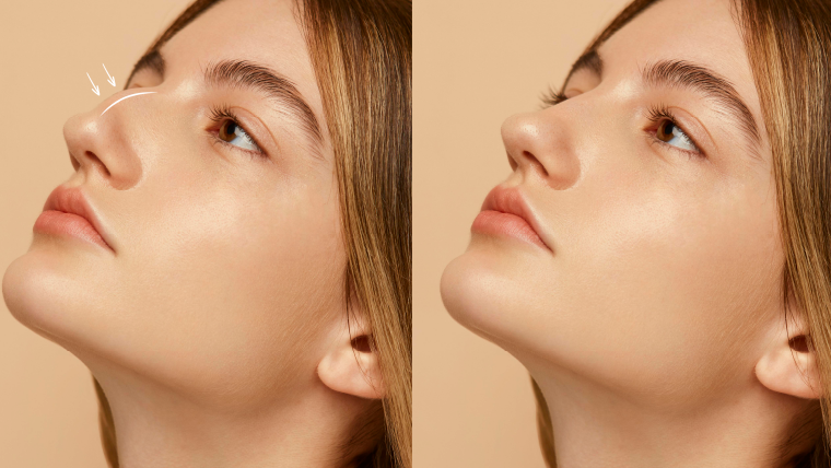 Rinoplastia Cali